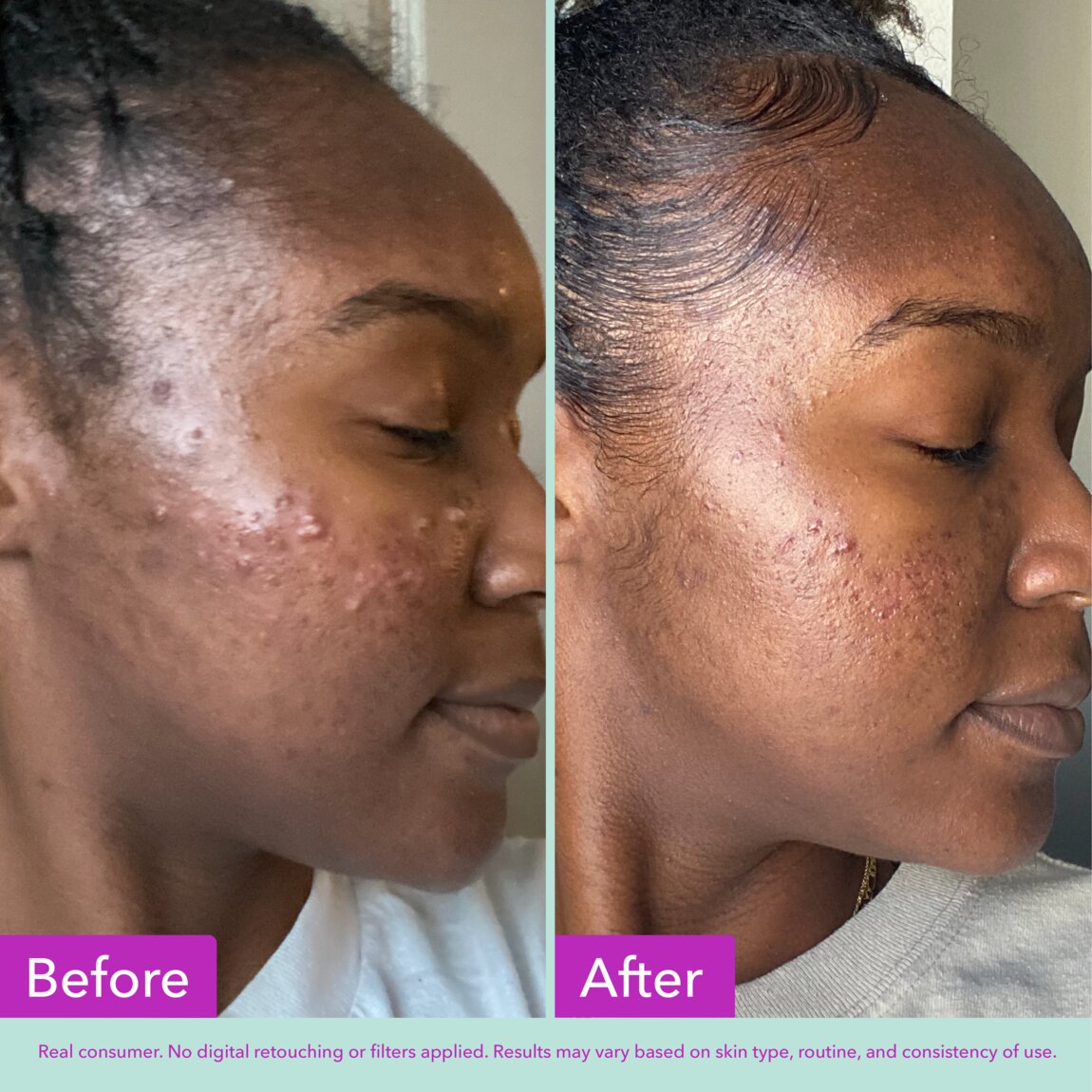 acne-foaming-cleanser-k4 zb_p.jpg