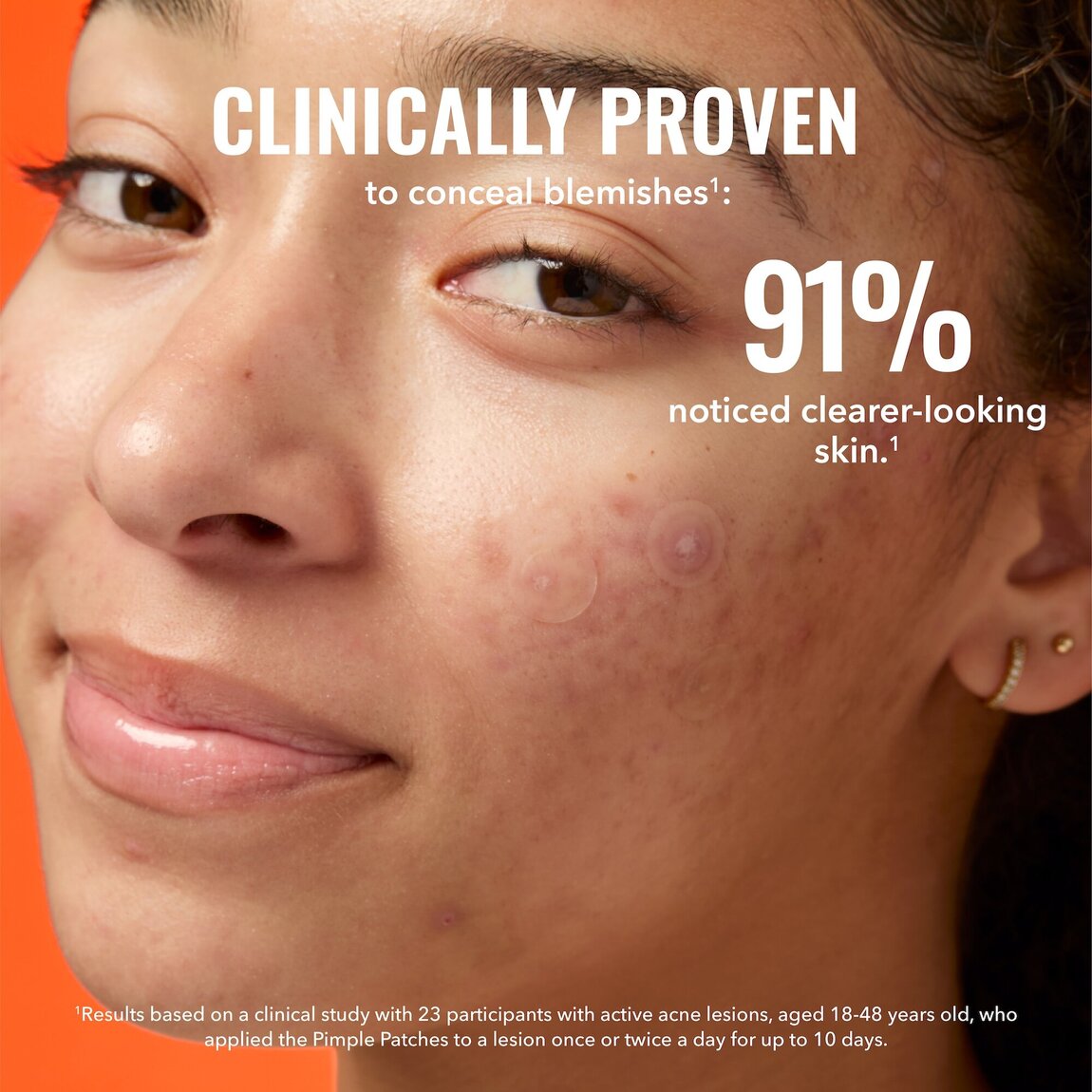 pimple-patches-l2 zb_p.jpg